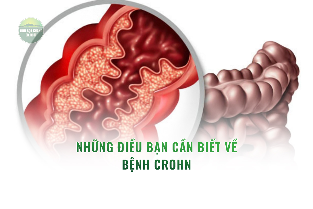 Những điều bạn cần biết về bệnh Crohn